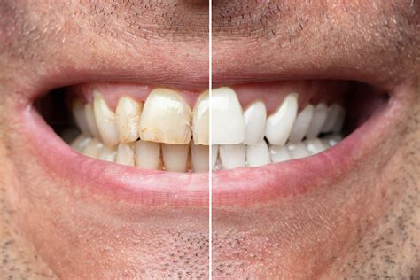 Smile Gallery Smile Transformations