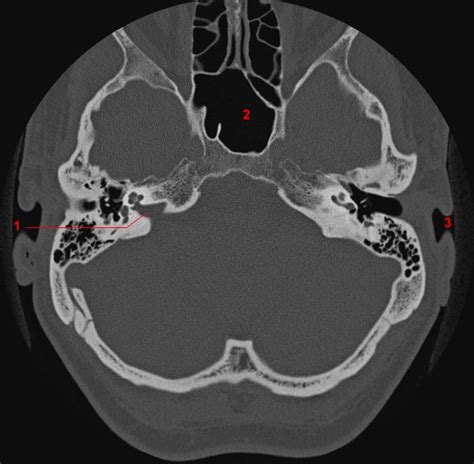 foramina   skull base ct  radiology
