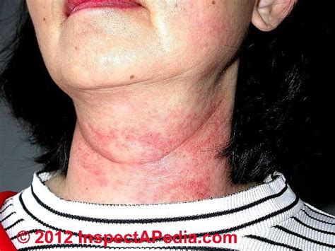 Neck Rash From Mold Exposure C D Friedman Mold Exposure Black Mold