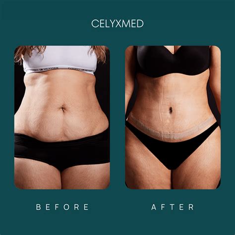 Tummy Tuck In Turkey All Included Celyxmed