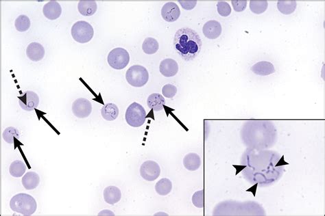 Babesiosis Clinicians Brief