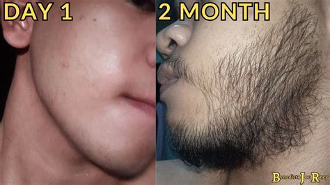 Minoxidil Beard Journey 2 Month Transformation Youtube