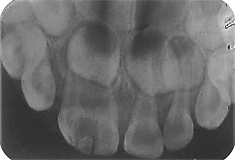 Placa De Radiografia Oclusal