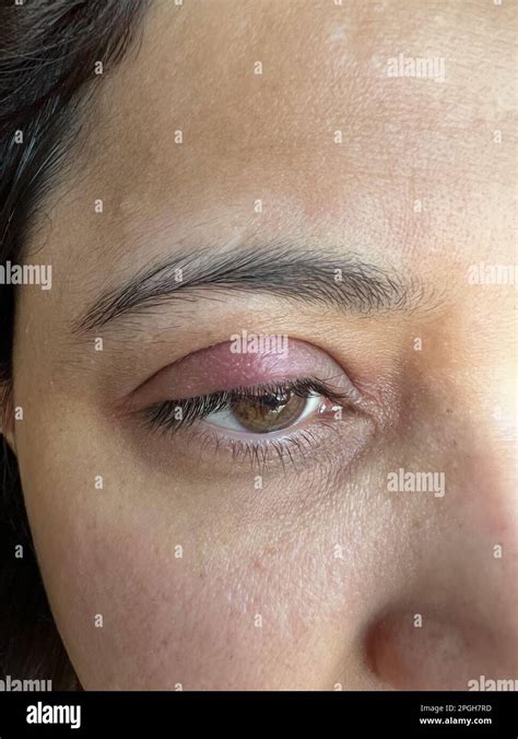 Close Up View Of A Swollen Eyelid Due To Bacterial Infection Red