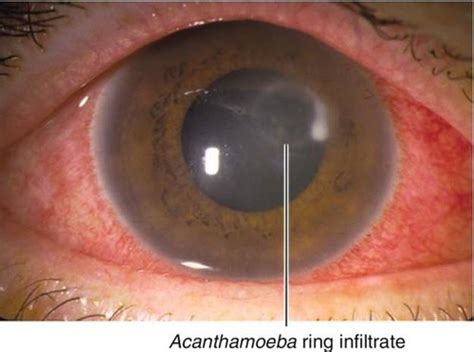 Acanthamoeba Keratitis Ring Infiltrate