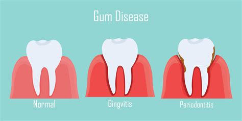 How To Get Rid Of Gingivitis