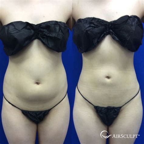 Pin On Airsculpt® Before And After Elite Body Sculpture