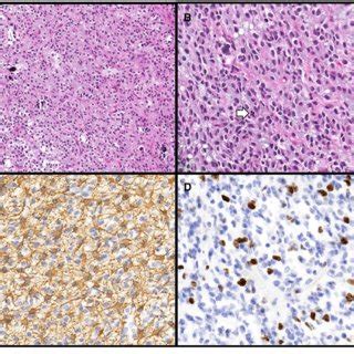 An adult male patient with localized pure germ cell tumor of the third ...