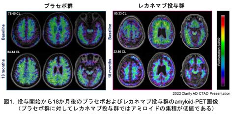 Aβイメージングによるアルツハイマー型認知症の診断 Himc 阪和インテリジェント医療センター