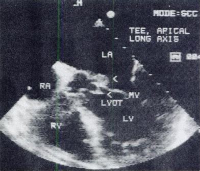 Value Of Transesophageal Echocardiography As An Adjunct To