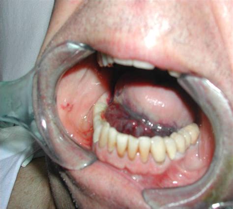 Floor Of Mouth Hematoma After Posterior Mandibular Implants Placement