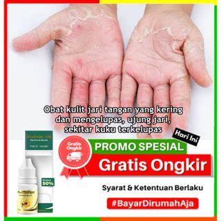 Jual Obat Kulit Jari Tangan Yang Kering Dan Mengelupas Ujung Jari