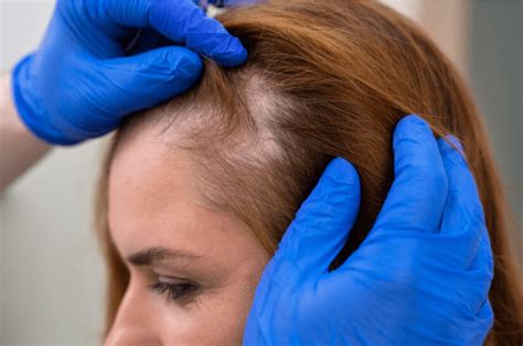 Does Ozempic Cause Hair Loss Green Relief Health