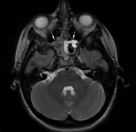 Lessons From Everyday Practice Septic Cavernous Sinus Thrombosis Due To Sphenoid Sinusitis In A