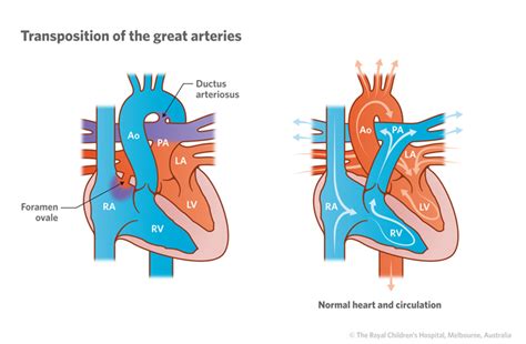 Cardiology Transposition Of The Great Arteries