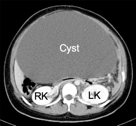 Giant Ovarian Serous Cystadenoma Radiology Cases