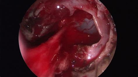 Prof Dr Aslan Güzel Trassfenoidal Hipofiz Tümörü Hıpofız Adenomu 1