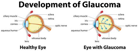 Glaucoma Detection, Damage Assessment via Deep Learning