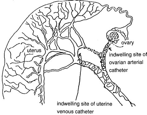 Indwelling Sites Of Ovarian Arterial And Uterine Venous Catheters