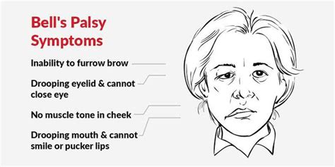 Bells Palsy Symptoms Medizzy