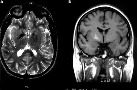 Unilateral Lesions Of The Globus Pallidus Report Of Four Patients Presenting With Focal Or