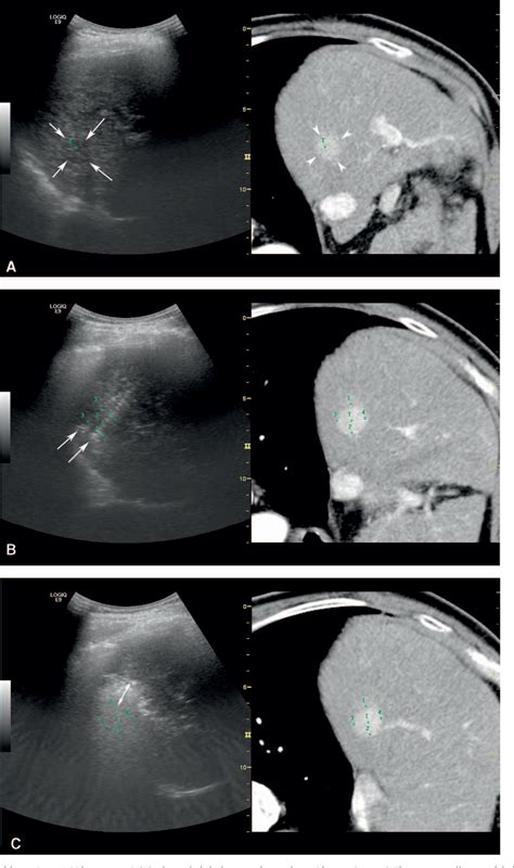 Figure 2 From Clinical Value Of CT MR US Fusion Imaging For