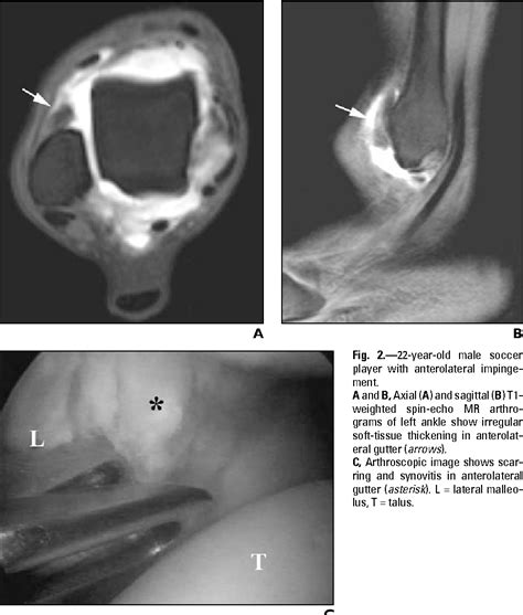 Figure 1 From Mr Imaging Of Ankle Impingement Syndromes Semantic Scholar