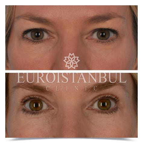 Eyelid Surgery Blepharoplasty All Inclusive Package 2 500