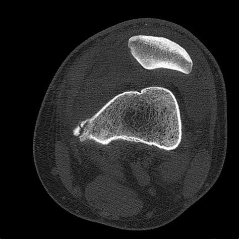 File Patellar Avulsion Fracture Articular Loose Body Old Stieda