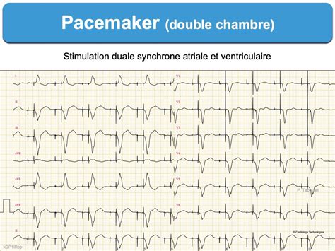 Spike E Cardiogram