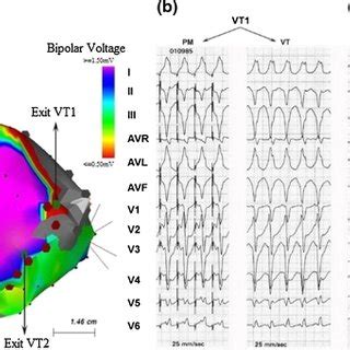 A Voltage Map During Sinus Rhythm Of The Left Ventricle In A