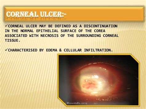 Bacterial Corneal Ulcer Etilogy Pathogenesis Pathology And Clinical