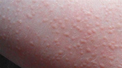 Hives Urticaria Skin Rash Treatment Hot Sex Picture