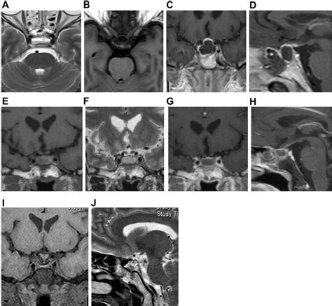 Figure 3 From Abnormal Magnetic Resonance Imaging Of The Sellar Region