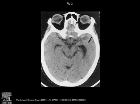 Tension Pneumocephalus Resulting From Iatrogenic Subarachnoidpleural