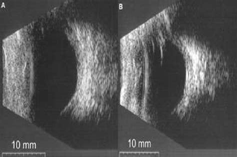 Échographie Oculaire En Mode B Montrant Un Aspect De Sclère épaisse A