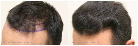 Hair Transplant before and after Pictures & Results | Dr. Rahal