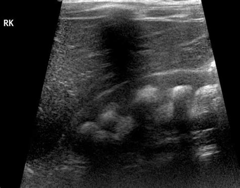 Renal Medullary Nephrocalcinosis Radiology Case