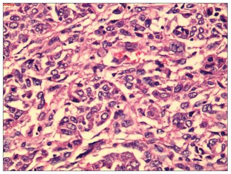 Undifferentiated Embryonal Sarcoma Of The Liver Mistaken For Hepatic