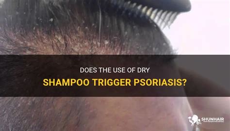 Does The Use Of Dry Shampoo Trigger Psoriasis Shunhair