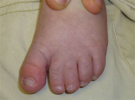 Toe Syndactyly More Thoughts Congenital Hand And Arm Differences