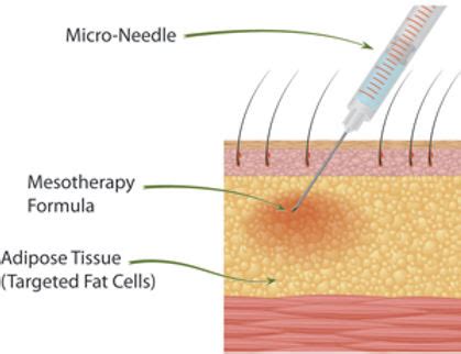 Injection Lipolysis