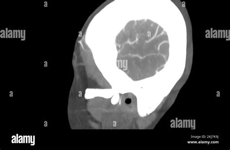 Angio Angiography MRI brain scan, Side view. Computed Tomography of the ...