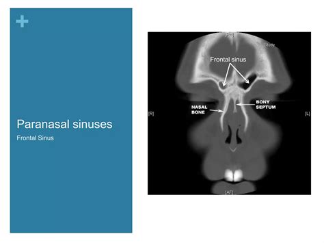 Nasal Cavity And Paranasal Sinuses Radiologic Anatomy Ppt