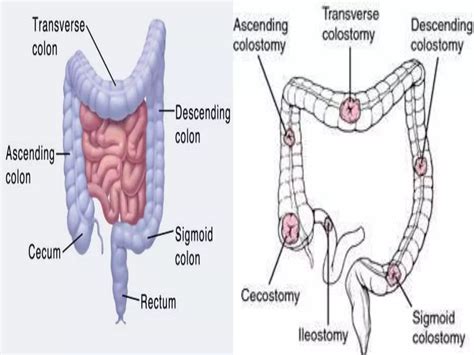 Colostomy care | PPT