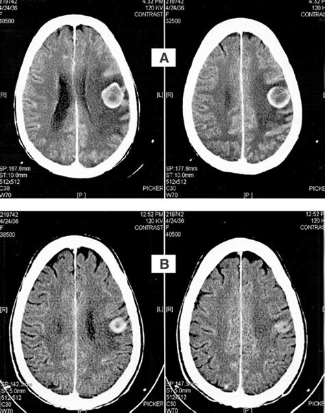 Small Cell Lung Cancer With Mets To Brain - CancerWalls