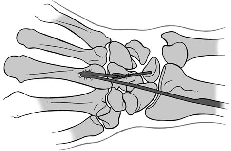 Surgical Technique Hemi Extensor Carpi Radialis Brevis Tenodesis For