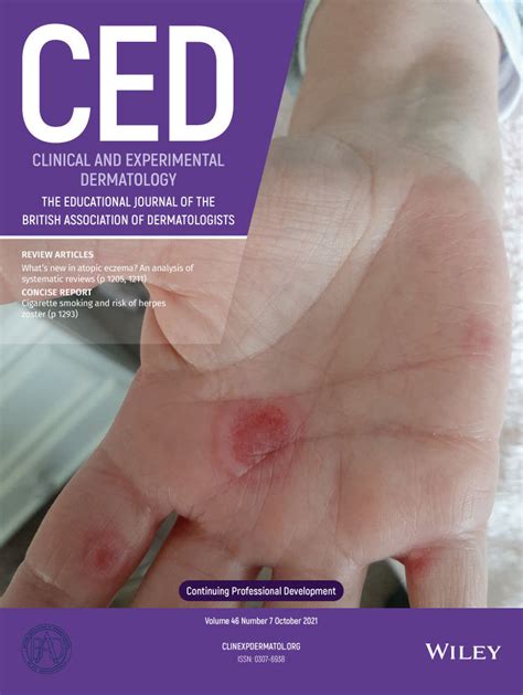 The Koebner Phenomenon Seen In A Case Of Drug‐induced Granular C3 Dermatosis Ohata