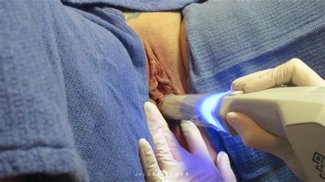 Vaginal Tightening And Rejuvenation Of Vaginal Canal Nude Video On Youtube Nudeleted