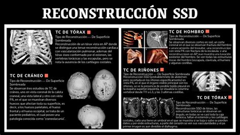 Reconstrucci N Ssd Tomo